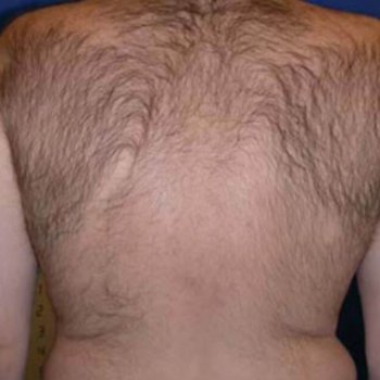 Laser Hair Removal | Hair Dermatologist | Dermatology SA Laser Hair Removal | Hair Dermatologist | Dermatology SA
