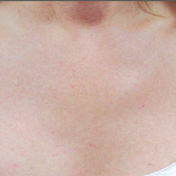 Before and After Pictures of Chest Crea with AFT Photorejuvenation Treatment.