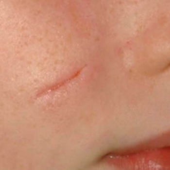Before and After Pictures of Cheek Smoothness with AFT Photorejuvenation Treatment.