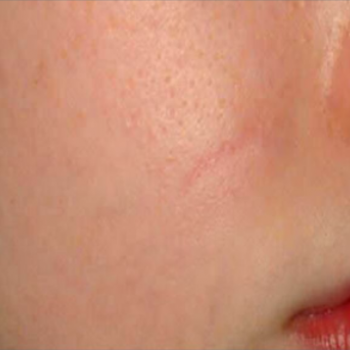 Before and After Pictures of Cheek Smoothness with AFT Photorejuvenation Treatment.