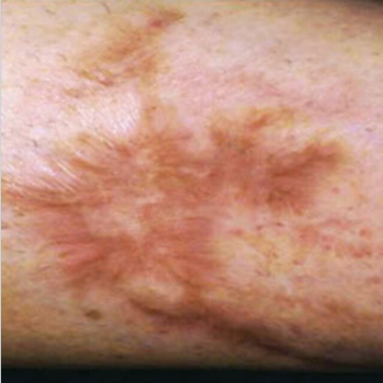 Before and After Pictures of Arm Scar with AFT Photorejuvenation Treatment.