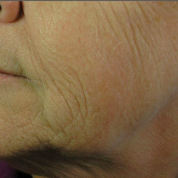 Before and After Pictures of Laugh Lines on the Left Side with AFT Photorejuvenation Treatment.