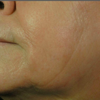 Before and After Pictures of Laugh Lines on the Left Side with AFT Photorejuvenation Treatment.