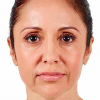 Before and After Pictures with Juvederm Family of Fillers for Facial Lines.