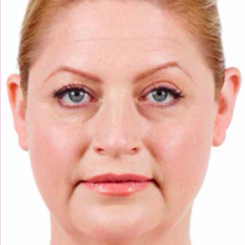 Before and After Pictures with Juvederm Family of Fillers for Laugh Lines