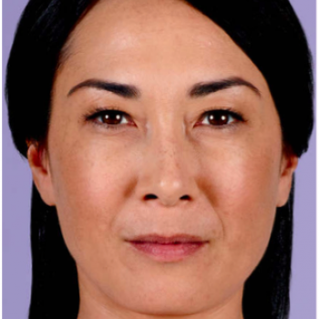 Before and After with Juvederm Family of Fillers for Frown LinesPictures