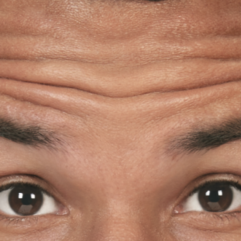 Before and After Pictures of Forehead Lines with Botox Cosmetic Treatment on a Male.