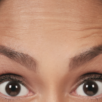 Before and After Pictures of Forehead Lines with Botox Cosmetic Treatment on a Female.