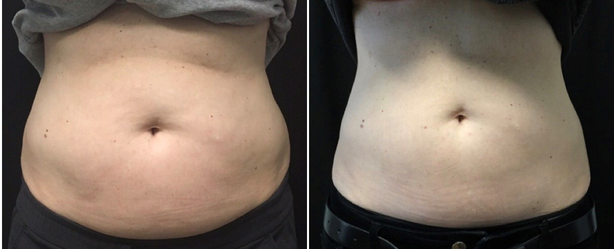 Before and After Pictures of CoolSculpting on Under Chin