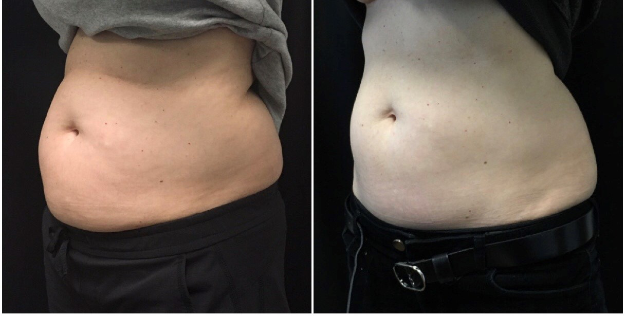 Before and After Pictures of CoolSculpting on Under Chin Side View