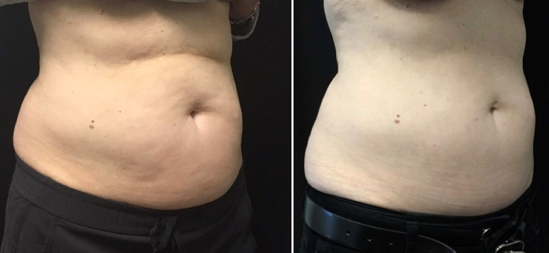 Before and After Pictures of CoolSculpting on Under Chin Side View for Male