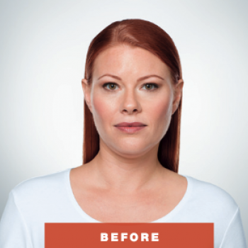 Before and After Pictures of Kybella Treament Front Side.