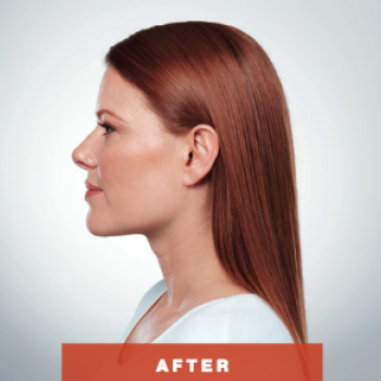 Before and After Pictures of Kybella Treament Side VIew.