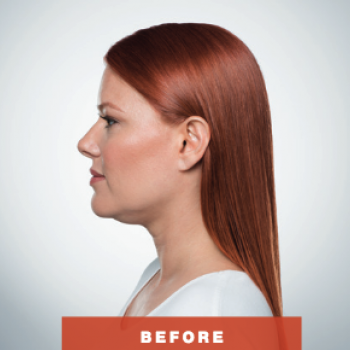 Before and After Pictures of Kybella Treament Side VIew.