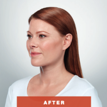 Before and After Pictures of Kybella Treatment Angle Side.