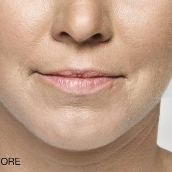Before and After Pictures of Restylane-L And Lyft Treatment for Lips.