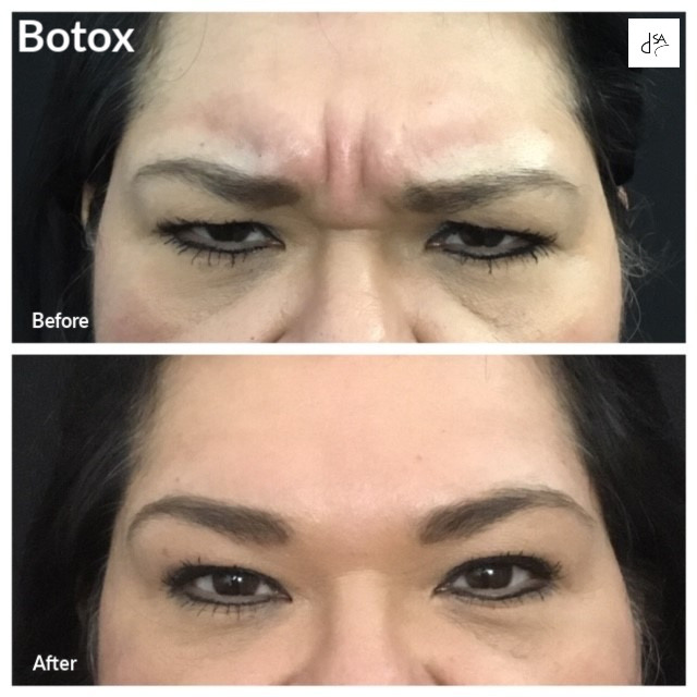 Before and After Pictures of Frown Lines with Botox Cosmetic Treatment on a Female.