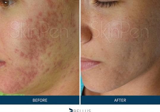 female SkinPen microneedling patient transformation