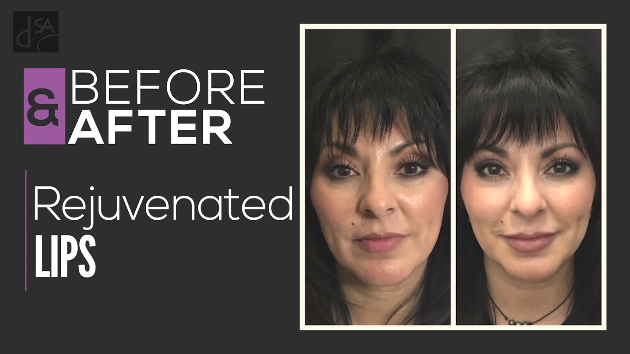 Rejuvenated Lips Thumbnail