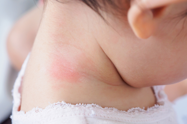 Child with Rash on their back